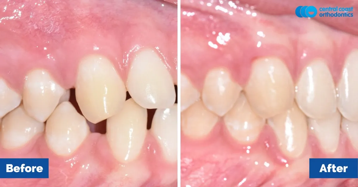 Before and after comparison, front view of the upper and lower teeth