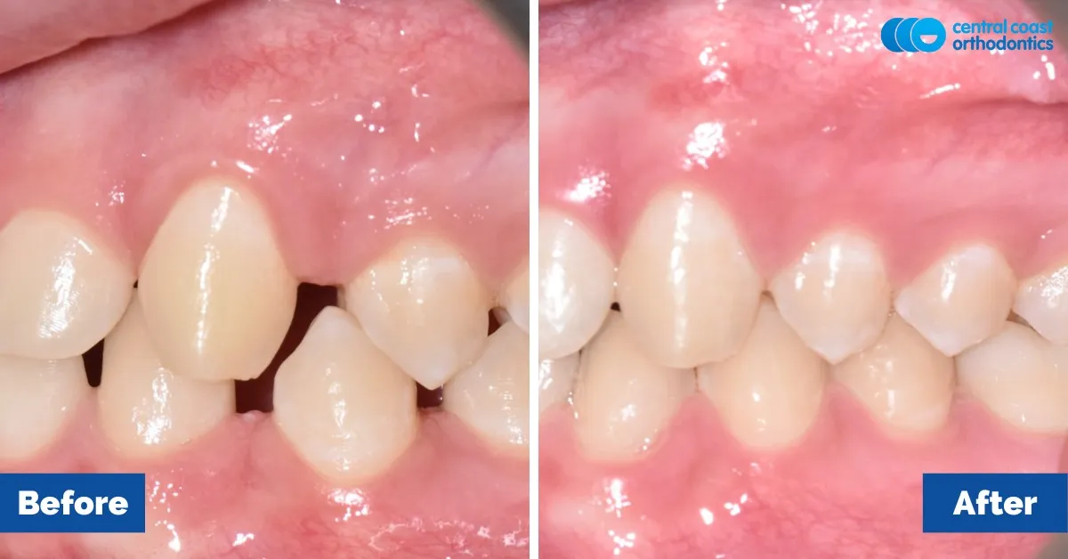 Before and after comparison, front view of the upper and lower teeth