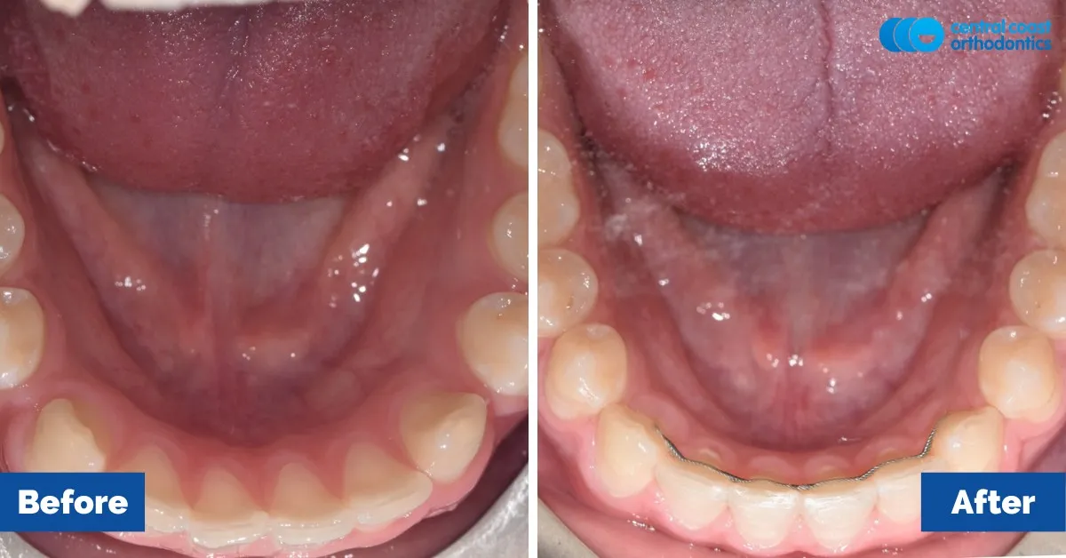 Before and after comparison, lower teeth viewed from above