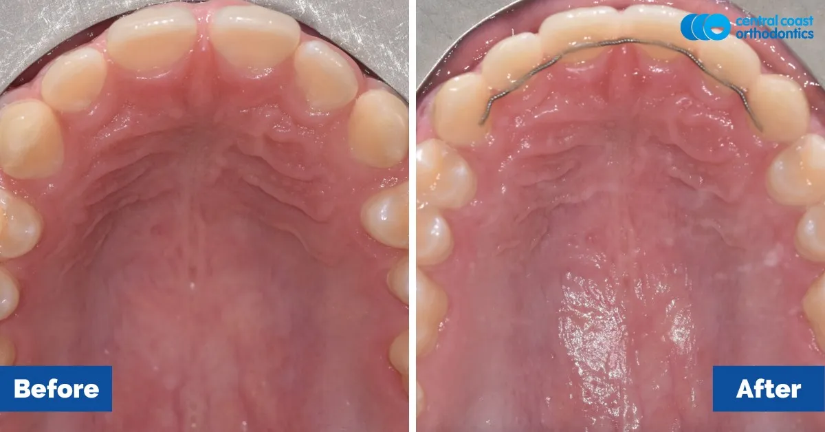 Before and after comparison, upper teeth viewed from below