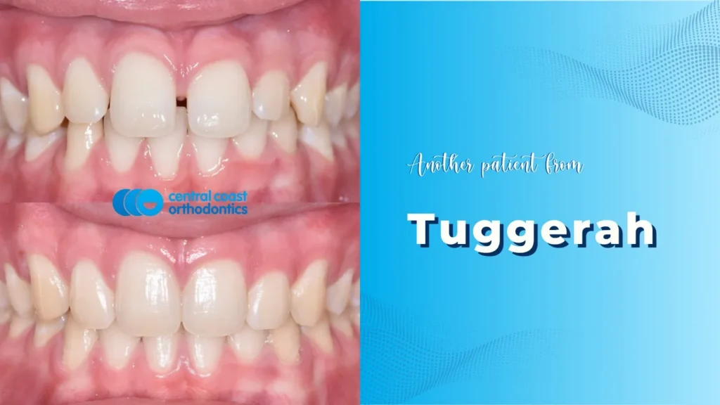 Before and after photographs of a Central Coast Orthodontics patient's teeth, labelled Tuggerah