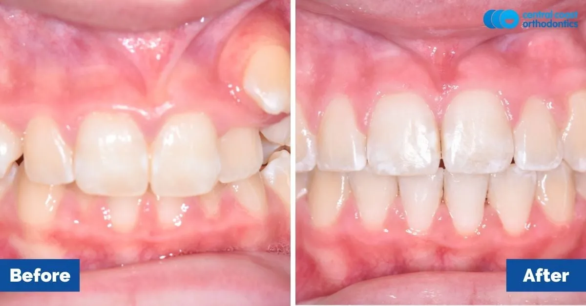 Before and after comparison, front view of the upper and lower teeth