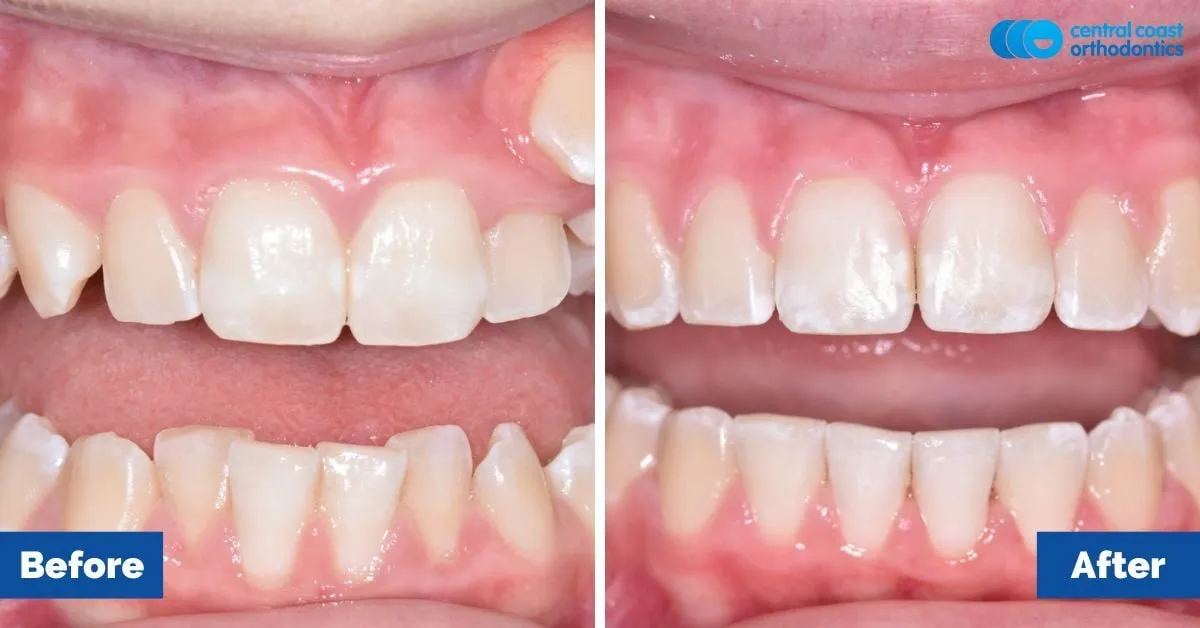 Before and after comparison, front view of the upper and lower teeth
