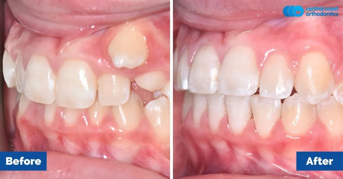 Before and after comparison, side view of the upper and lower teeth