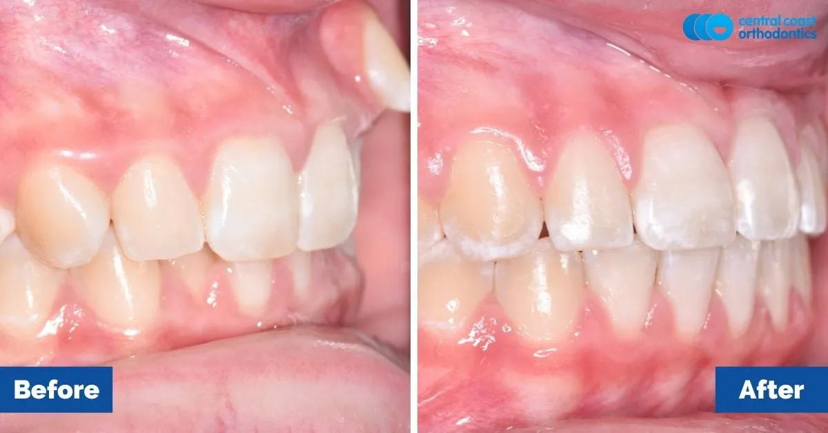 Before and after comparison, side view of the upper and lower teeth