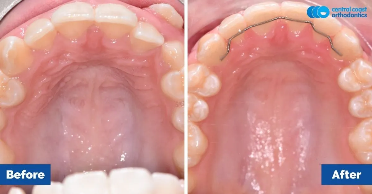 Before and after comparison, upper teeth viewed from below