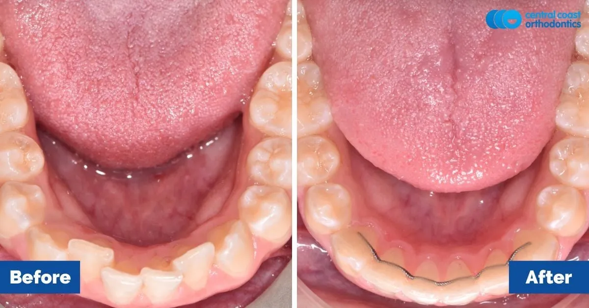 Before and after comparison, lower teeth viewed from above
