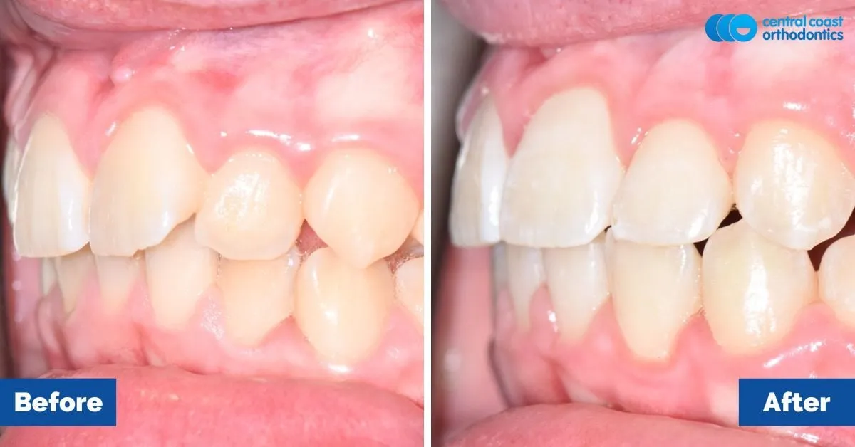 Before and after comparison, side view of the upper and lower teeth