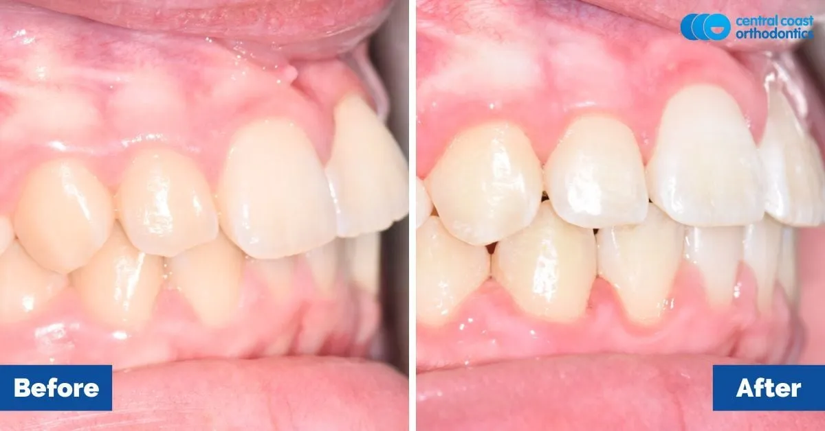Before and after comparison, side view of the upper and lower teeth
