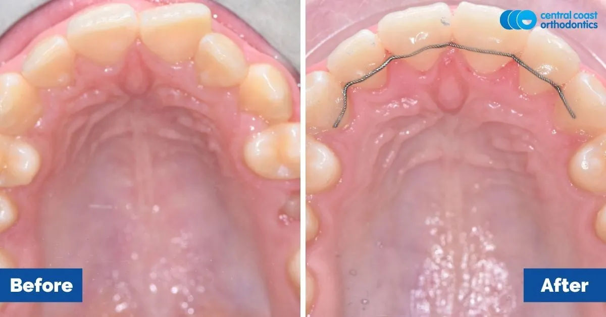 Before and after comparison, upper teeth viewed from below