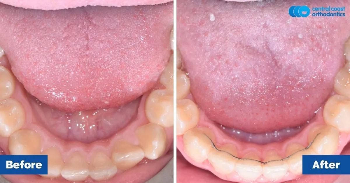 Before and after comparison, lower teeth viewed from above