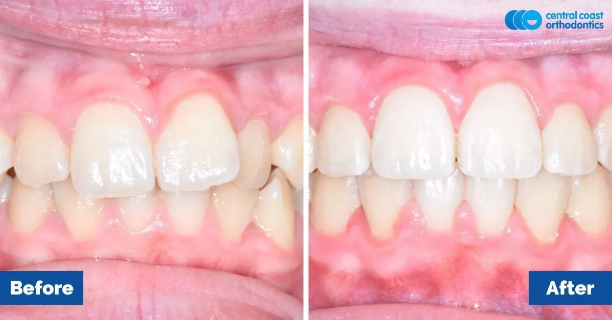 Before and after comparison, front view of the upper and lower teeth