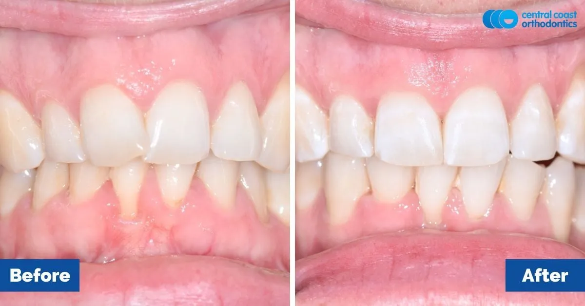 Before and after comparison, front view of the upper and lower teeth