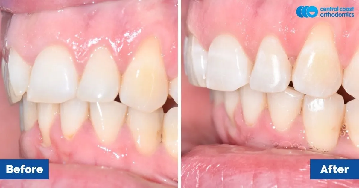 Before and after comparison, side view of the upper and lower teeth