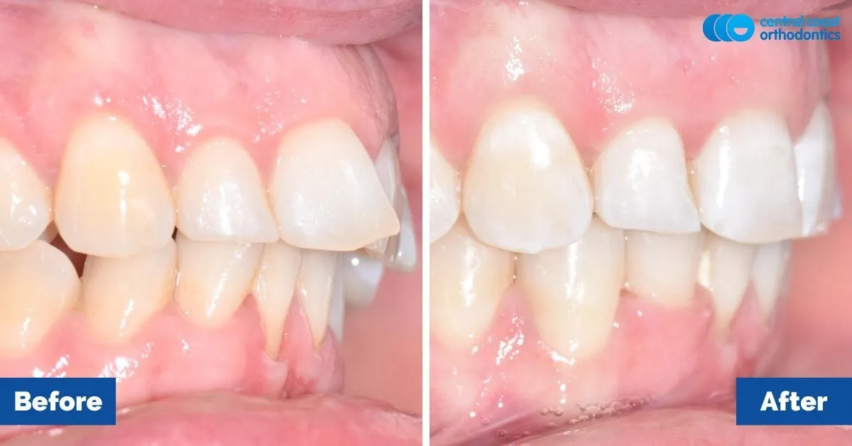 Before and after comparison, side view of the upper and lower teeth