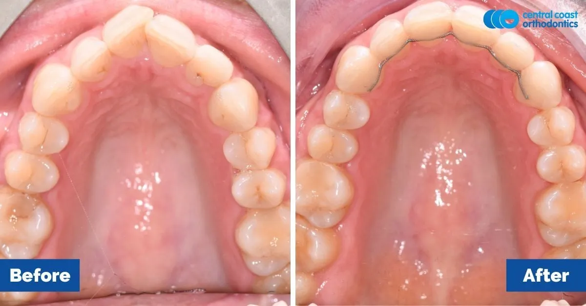 Before and after comparison, upper teeth viewed from below