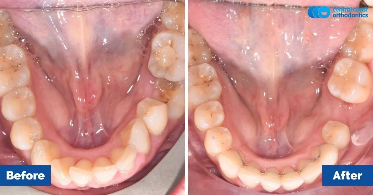 Before and after comparison, upper teeth viewed from below
