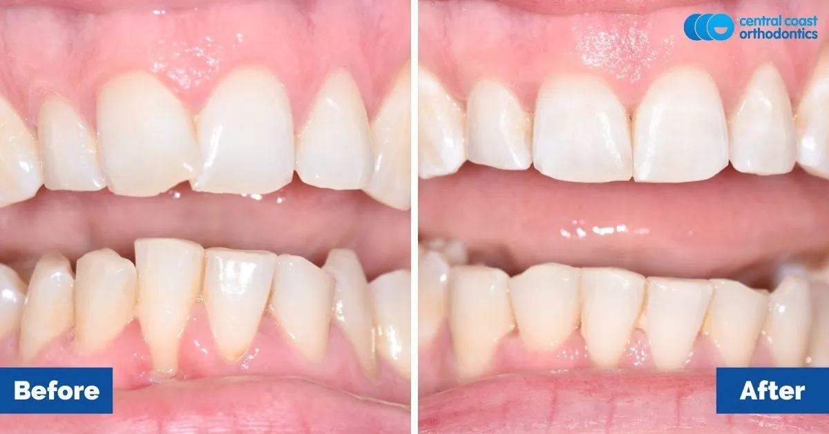 Before and after comparison, front view of the upper and lower teeth