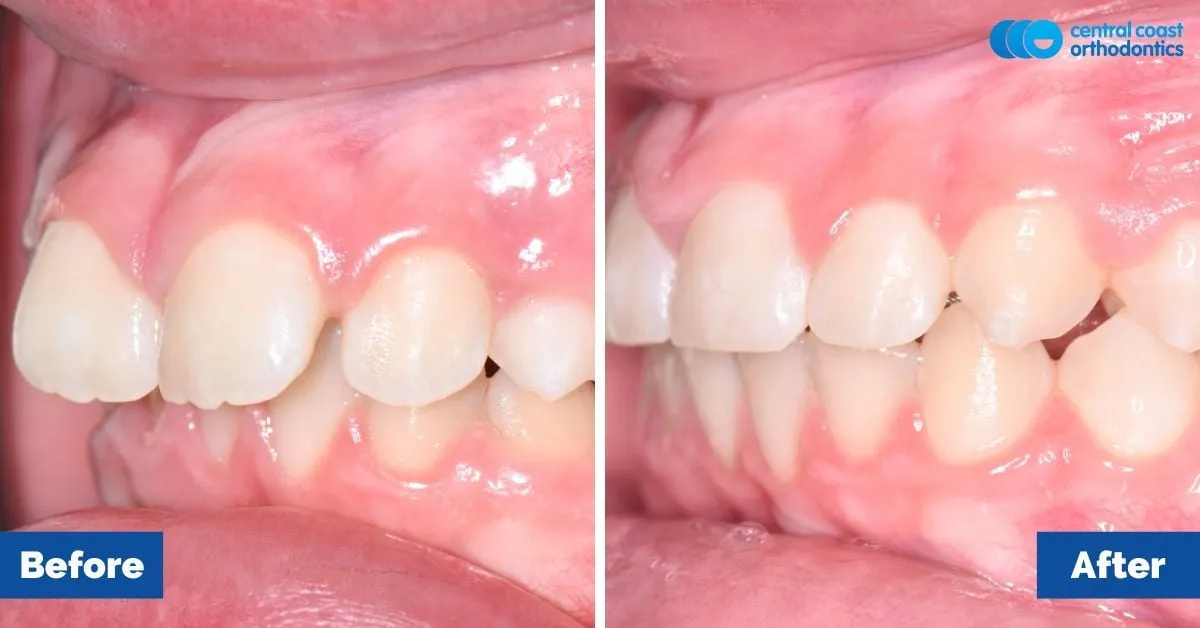 Before and after comparison, side view of the upper and lower teeth