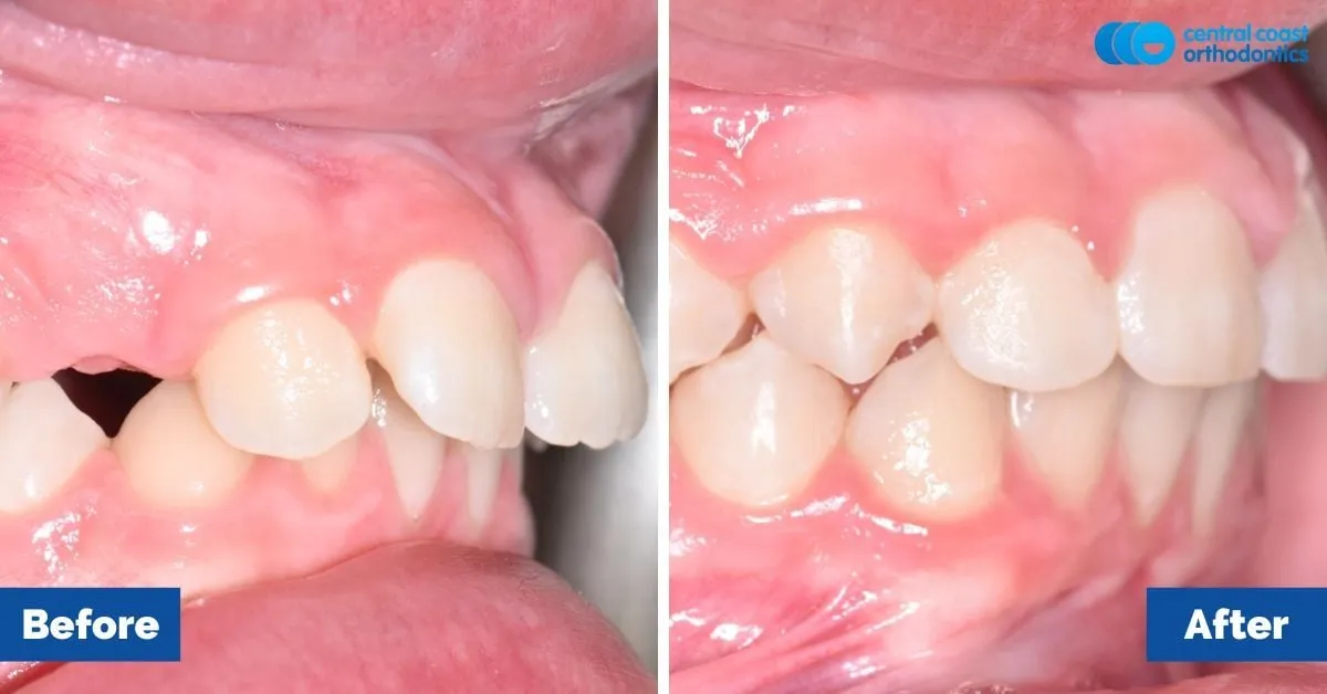 Before and after comparison, side view of the upper and lower teeth
