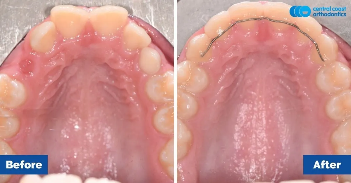 Before and after comparison, upper teeth viewed from below