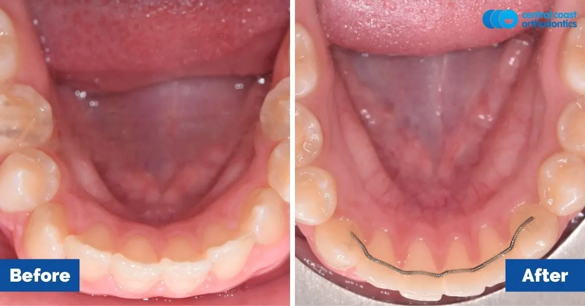 Before and after comparison, lower teeth viewed from above