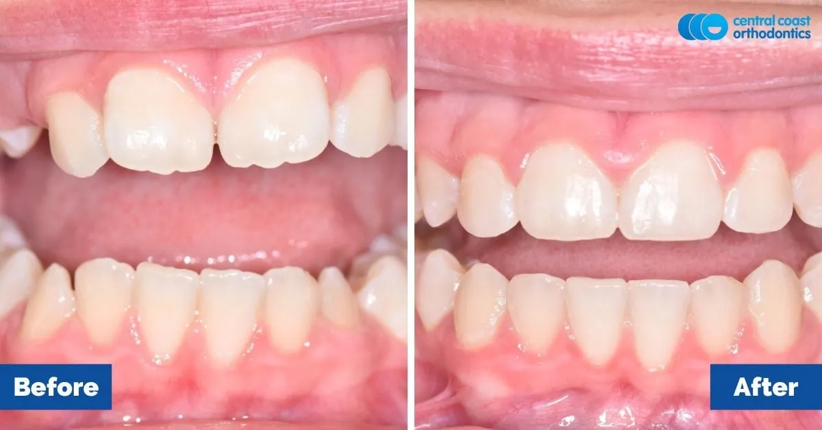 Before and after comparison, front view of the upper and lower teeth