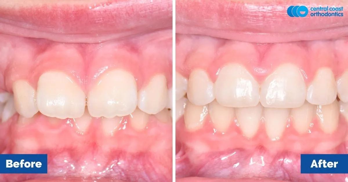 Before and after comparison, front view of the upper and lower teeth
