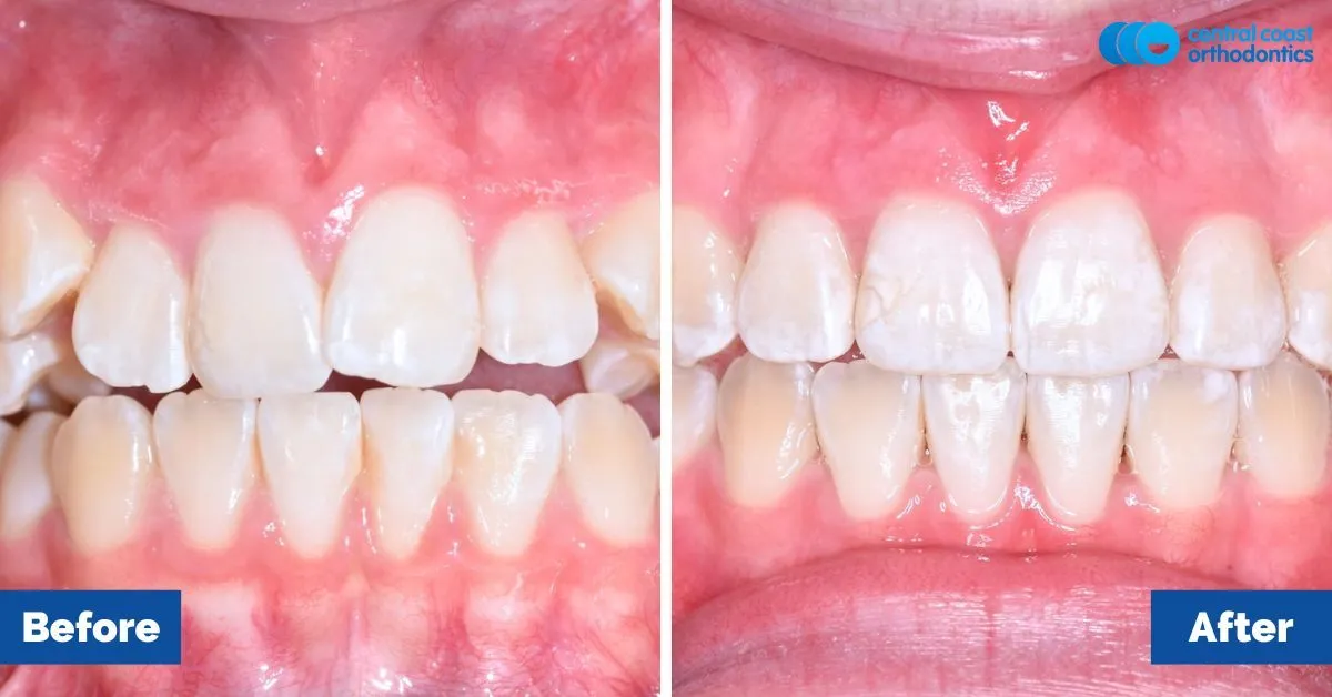 Before and after comparison, front view of the upper and lower teeth