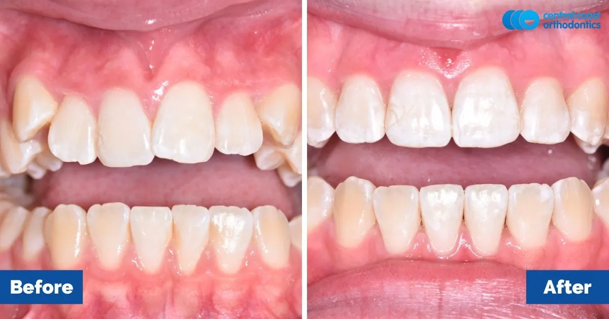 Before and after comparison, front view of the upper and lower teeth