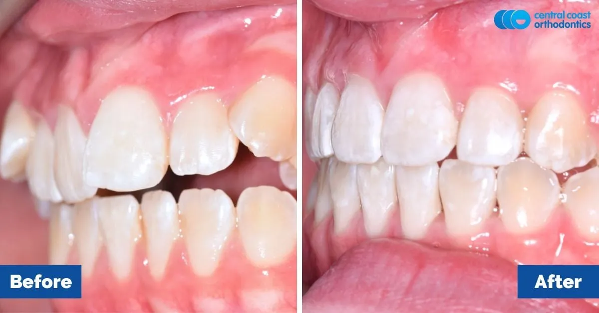 Before and after comparison, side view of the upper and lower teeth