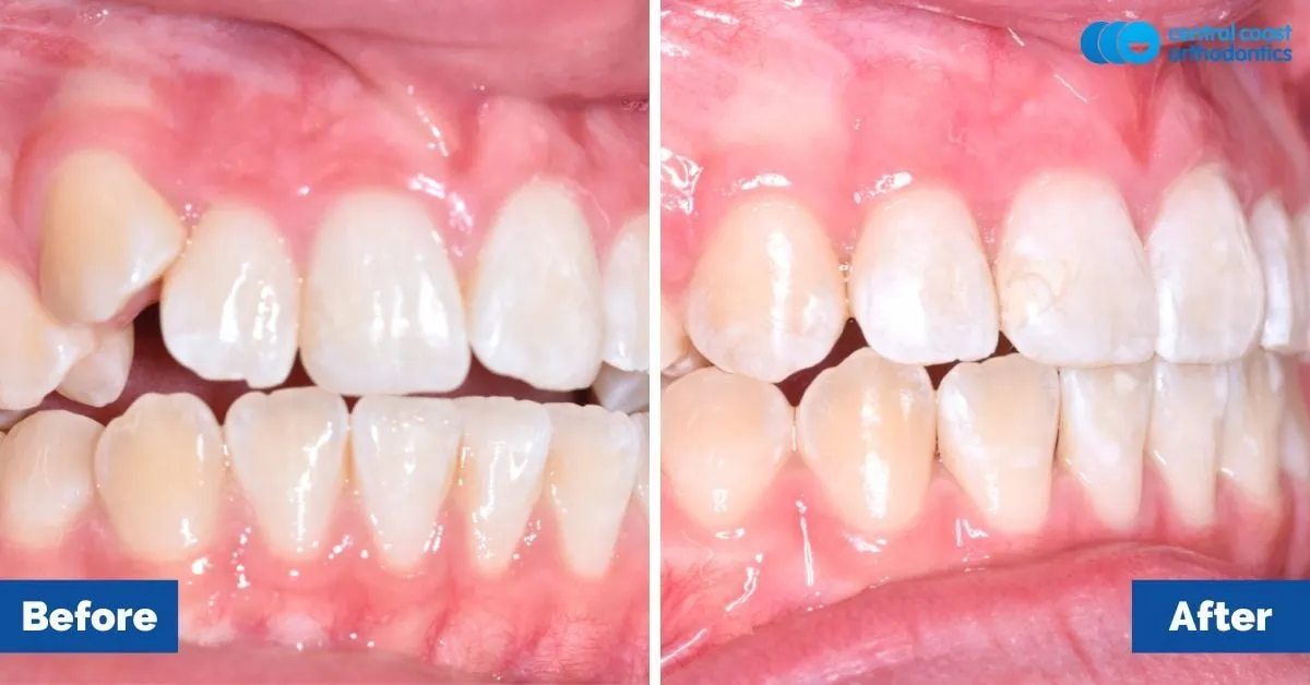 Before and after comparison, side view of the upper and lower teeth