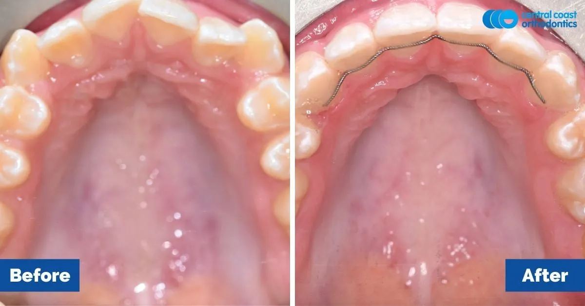 Before and after comparison, upper teeth viewed from below