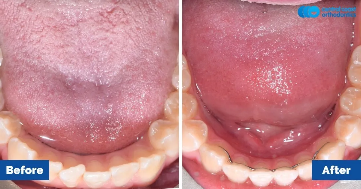 Before and after comparison, lower teeth viewed from above