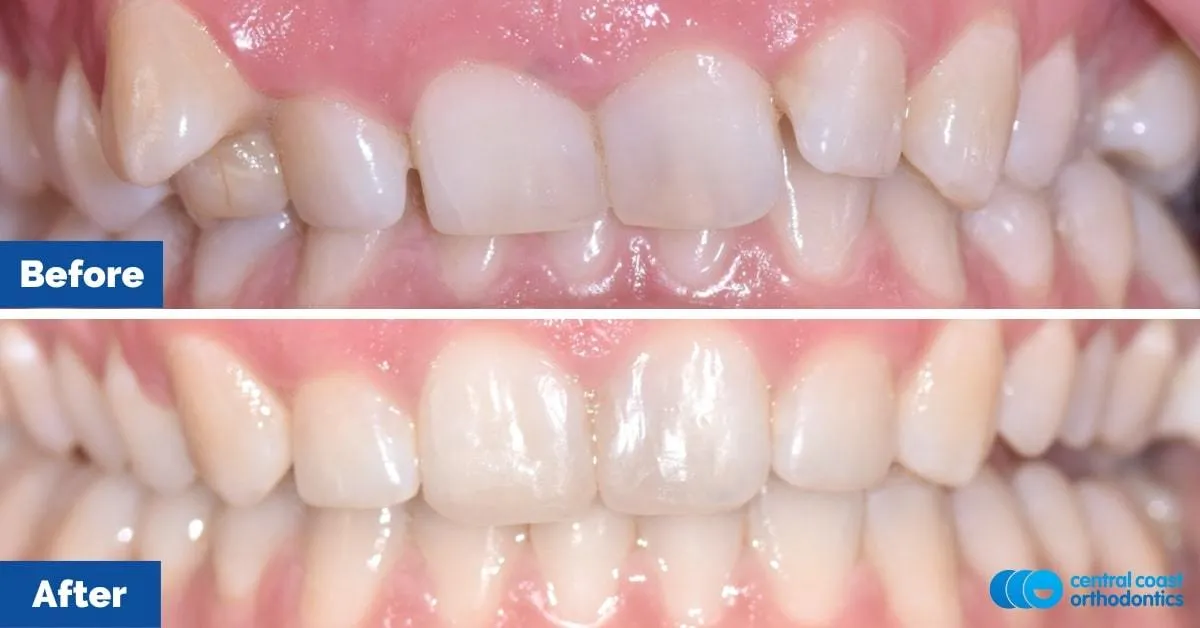 Before and after comparison, front view of the upper and lower teeth