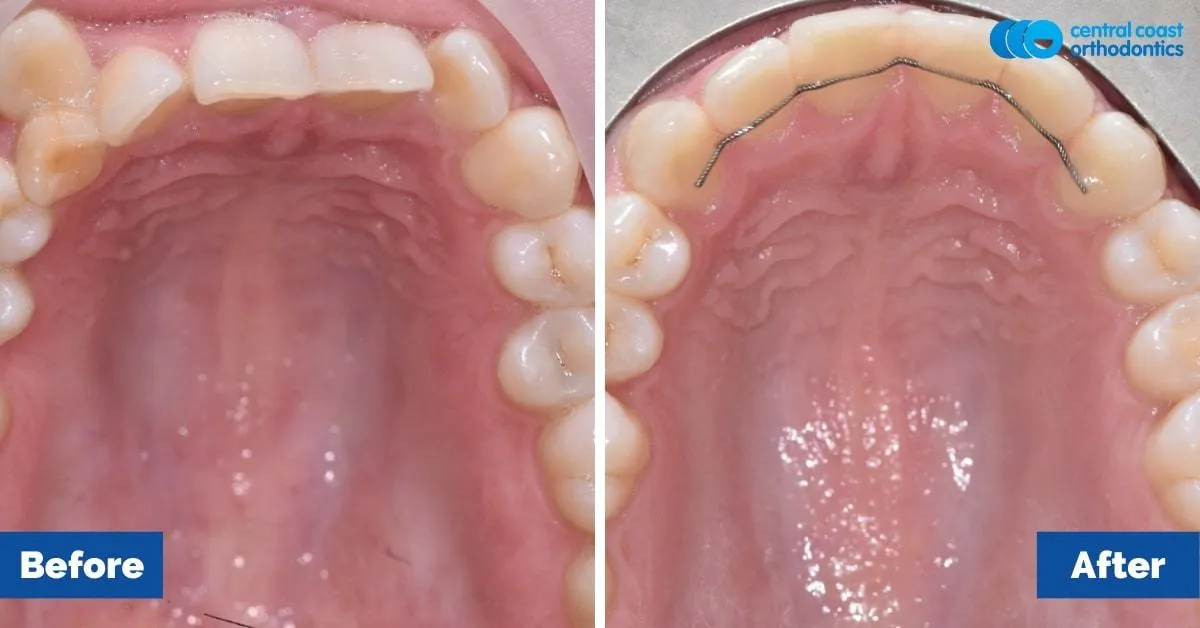 Before and after comparison, upper teeth viewed from below