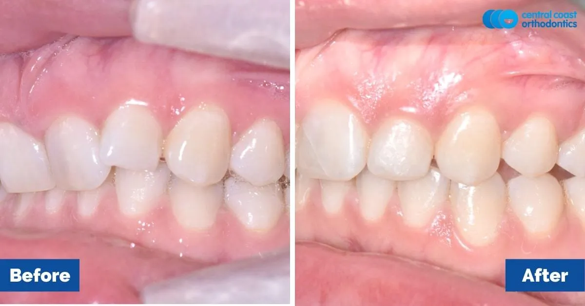 Before and after comparison, side view of the upper and lower teeth