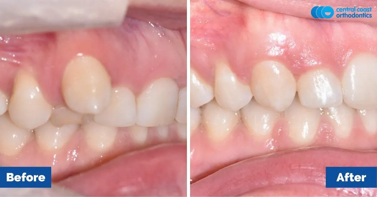Before and after comparison, side view of the upper and lower teeth