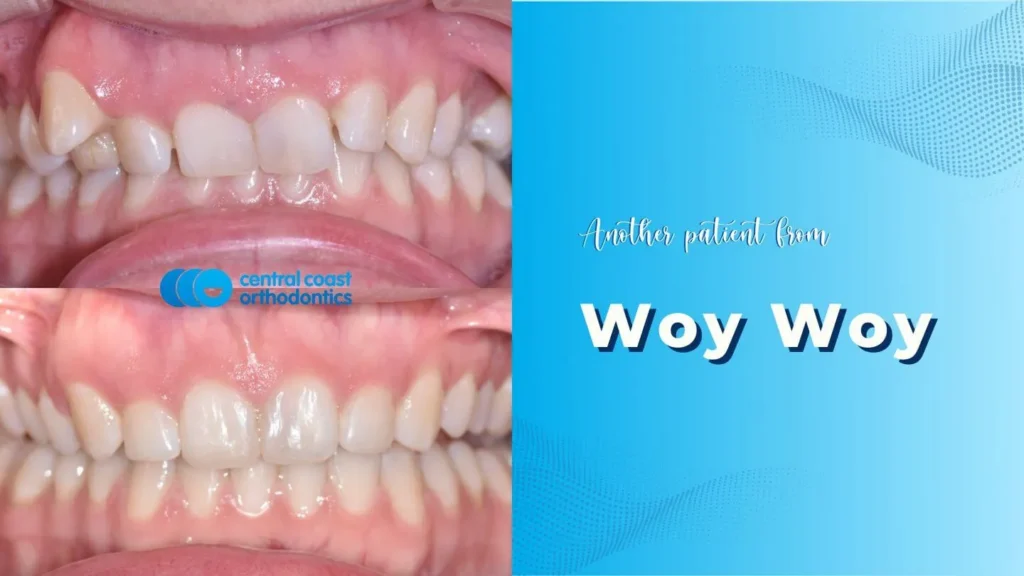Before and after photographs of a Central Coast Orthodontics patient's teeth, labelled Woy Woy