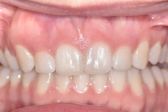 Patient of Woy Woyu2019s Braces Makeover