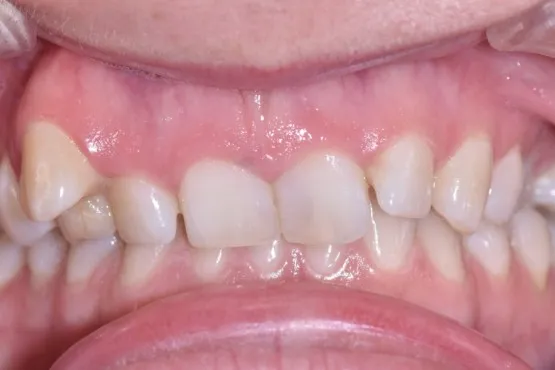 Patient of Woy Woyu2019s Braces Makeover