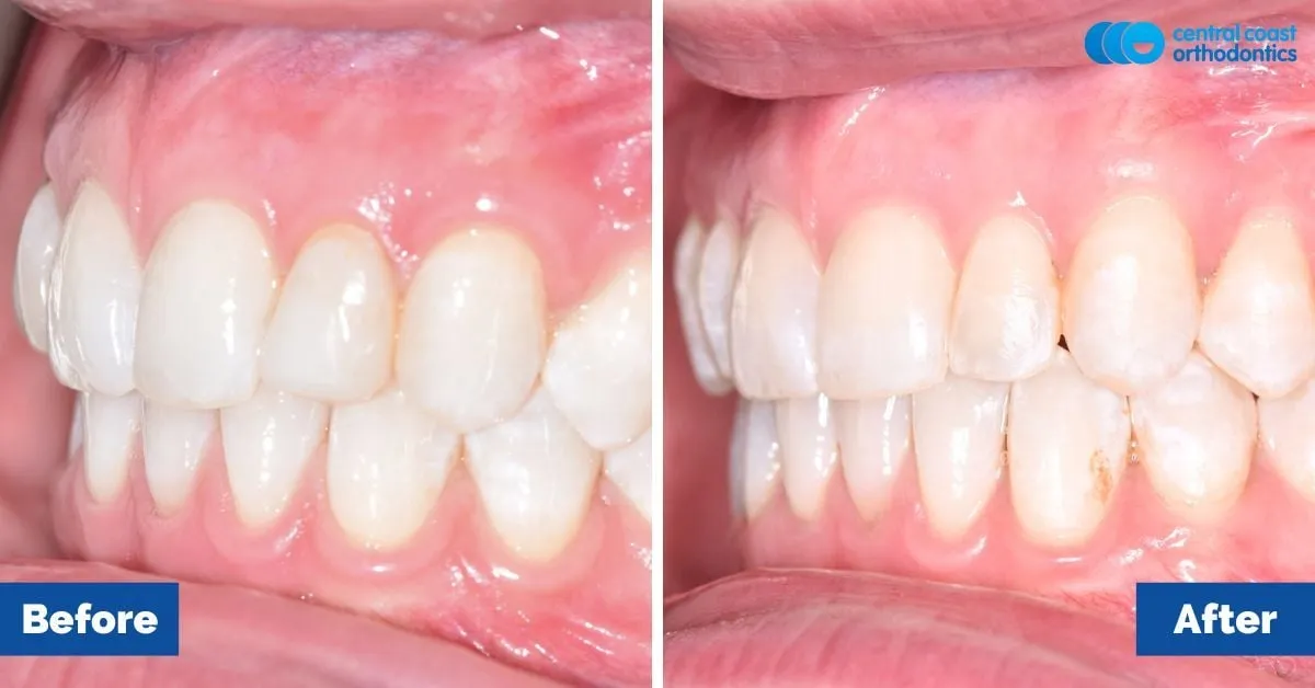 Before and after comparison, side view of the upper and lower teeth