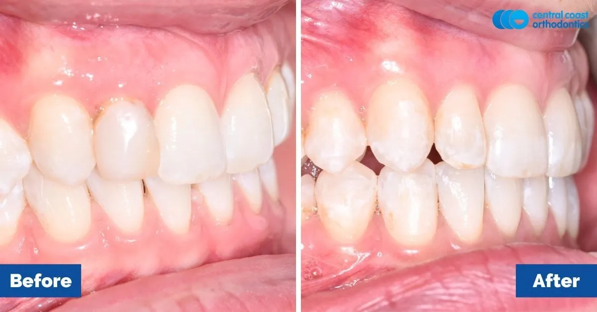 Before and after comparison, side view of the upper and lower teeth
