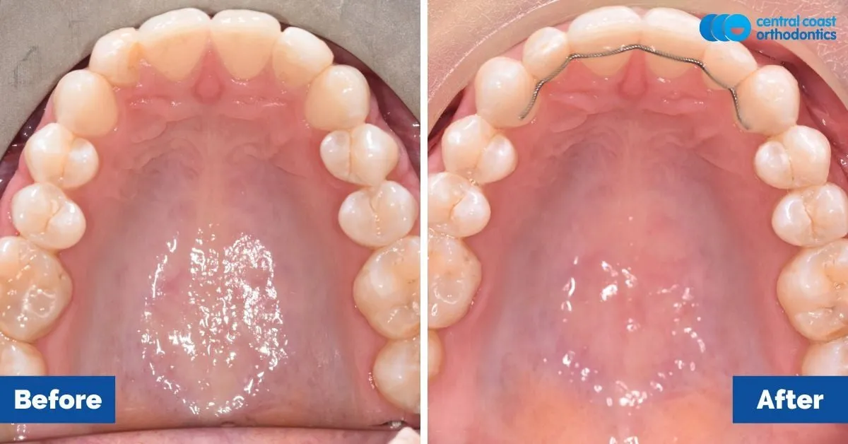 Before and after comparison, upper teeth viewed from below
