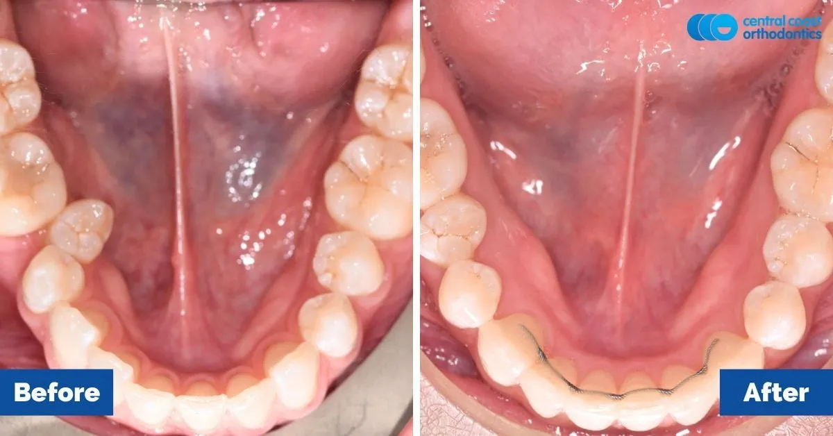 Before and after comparison, lower teeth viewed from above