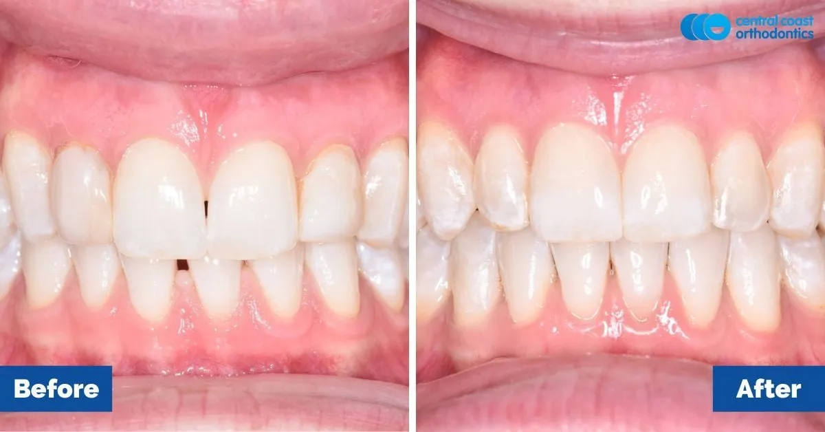 Before and after comparison, front view of the upper and lower teeth