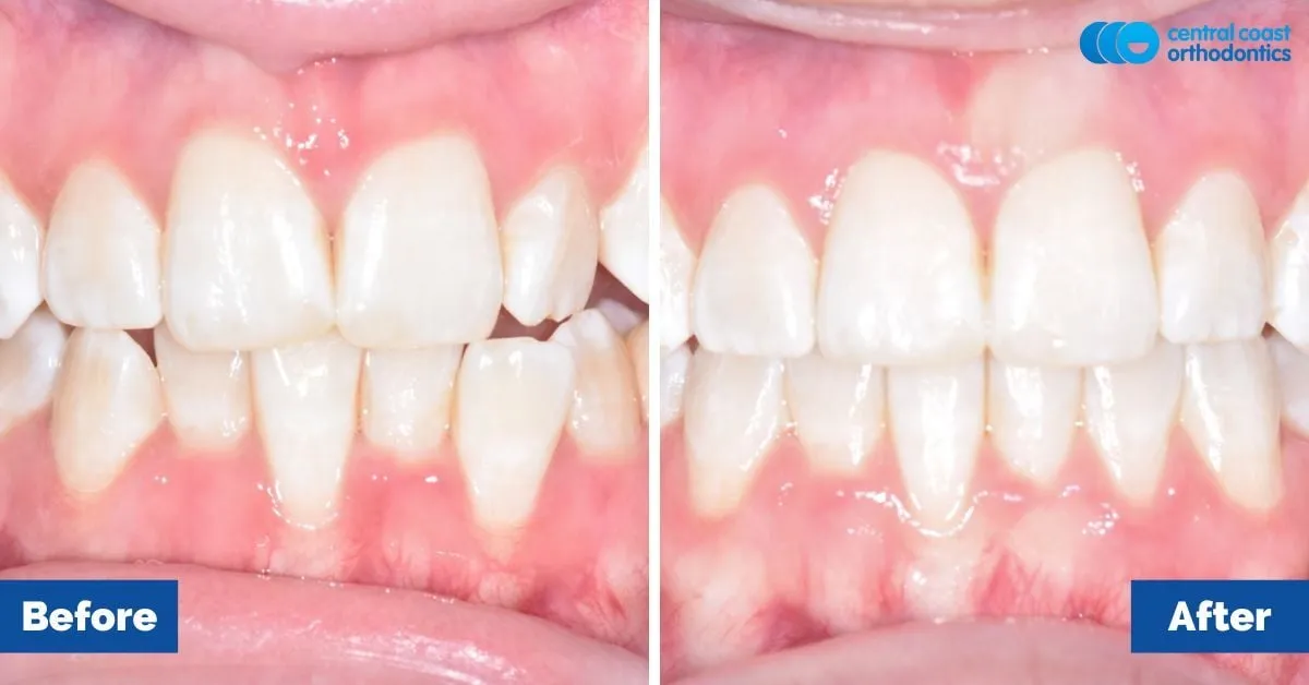 Before and after comparison, front view of the upper and lower teeth