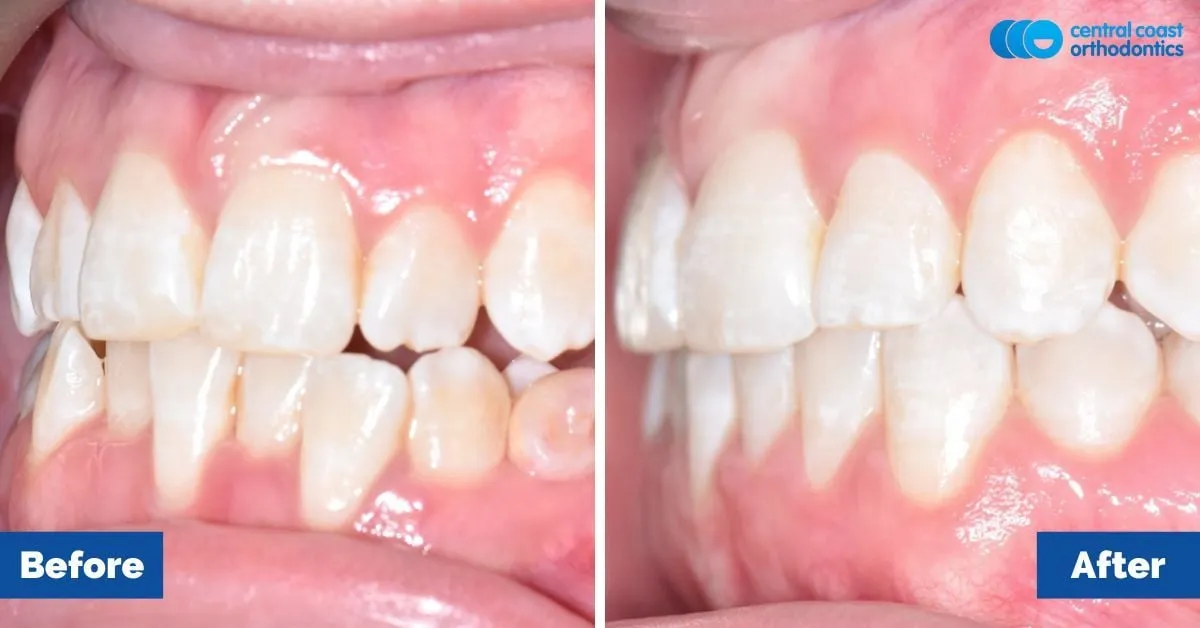 Before and after comparison, side view of the upper and lower teeth