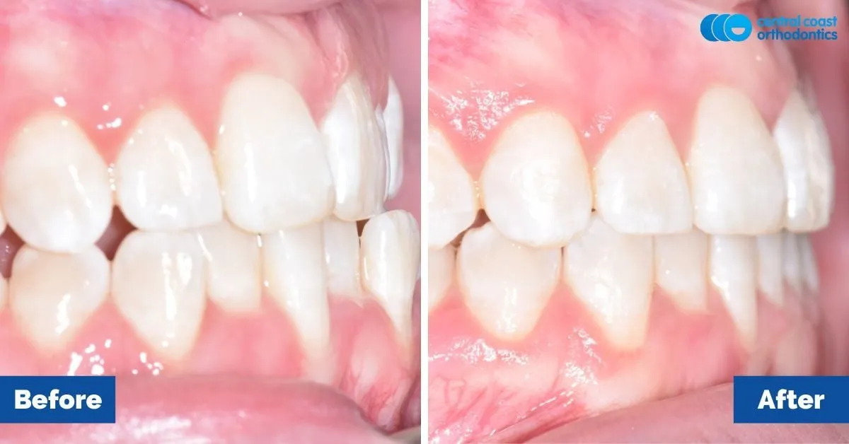 Before and after comparison, front view of the upper and lower teeth