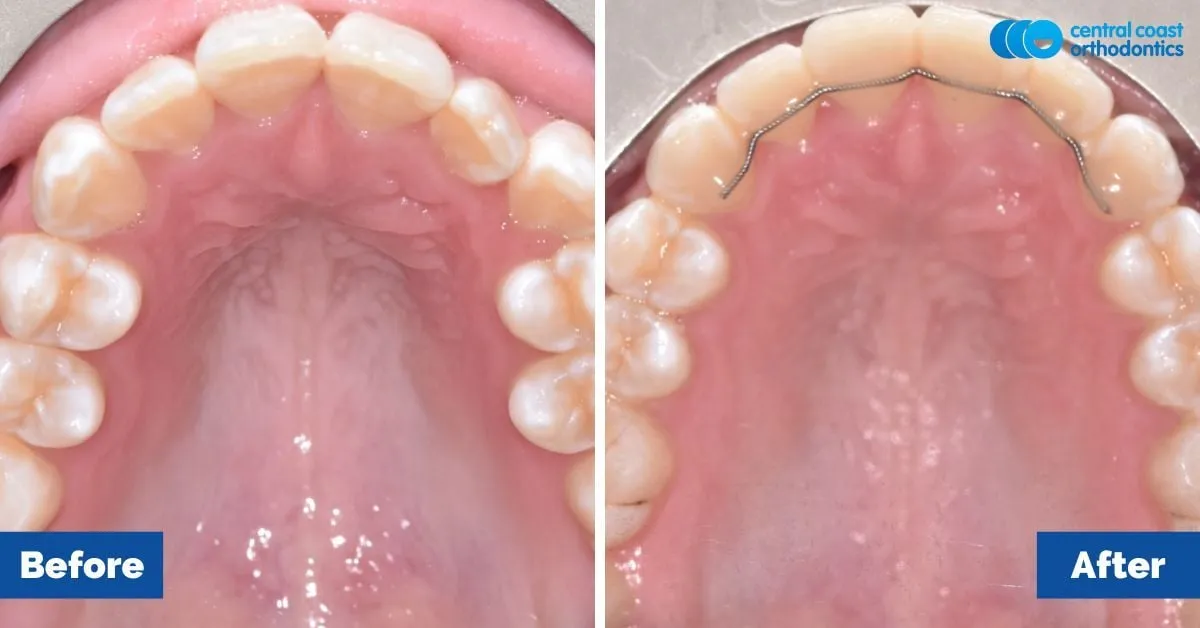 Before and after comparison, upper teeth viewed from below